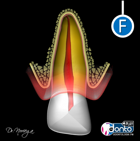 Reconstrucción final